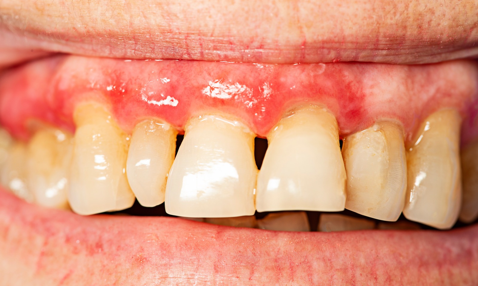 Meth Dental Issues a.k.a. Meth Mouth